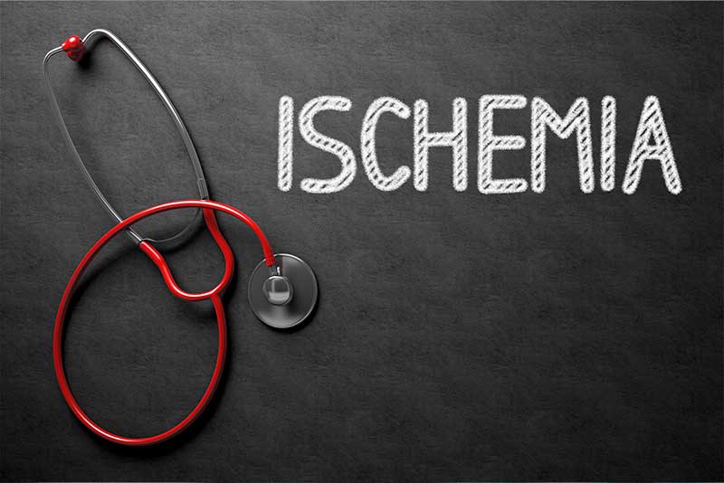 What is Ischemia? Why Is It A Major Cause Of Peripheral Neuropathy? - Peripheral Neuropathy