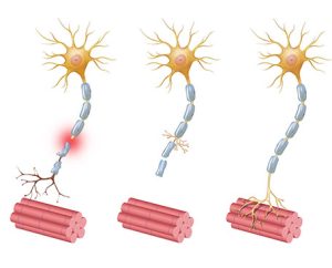 Top 12 Peripheral Neuropathy Symptoms - What is the best treatment for peripheral neuropathy without any dangerous drugs or surgery?