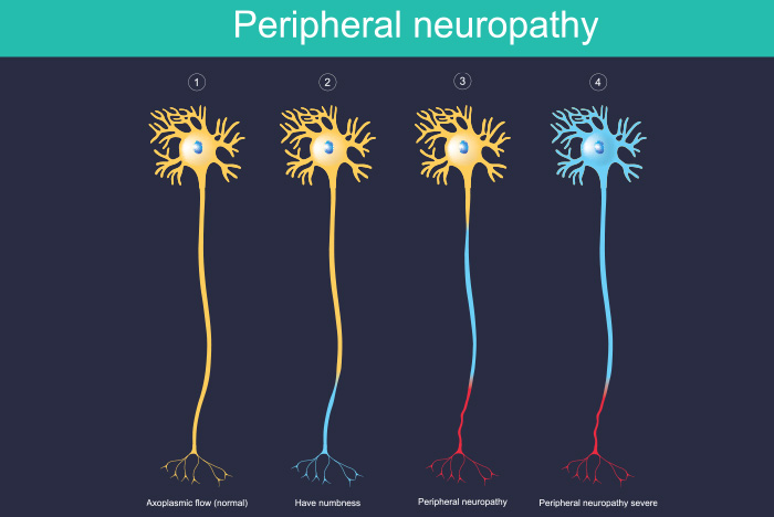 Evaluación de la seguridad, viabilidad y eficacia de las técnicas de neuromodulación no invasivas en la neuropatía periférica inducida por quimioterapia: una revisión sistemática. El uso de técnicas de neuromodulación no invasivas para controlar la CIPN aún está en sus inicios