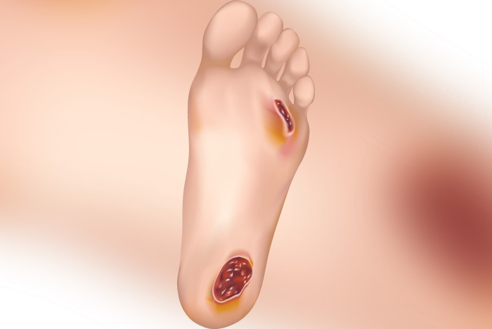 Revisión de investigación del Centro de alivio de la neuropatía de Miami: terapia fotodinámica con RLP068 y luz LED roja de 630 nm en úlceras de pie en pacientes con diabetes: una serie de casos. El manejo y cicatrización de las úlceras de las extremidades inferiores siempre ha sido un problema de salud complejo debido a que el curso clínico suele ser crónico