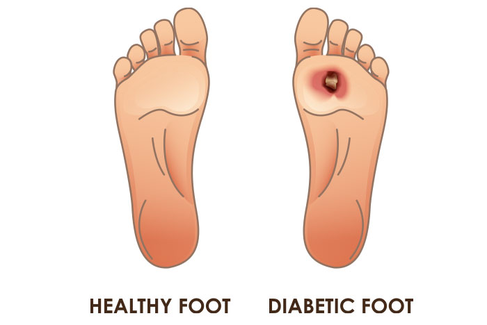 Randomized Controlled Trial Treatment of diabetic foot ulcers in a frail population with severe co-morbidities using at-home photobiomodulation laser therapy: a double-blind, randomized, sham-controlled pilot clinical study. To evaluate the safety and efficacy of an at-home photobiomodulation (PBM) device for the treatment of diabetic foot ulcers (DFUs) in a frail population with severe comorbidities.