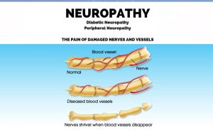 Neuropathy Relief Miami. Dr. Alfonso (Neuropathy Relief Center of Miami) Treatment Protocol. Fortunately, relief is possible, and one of the most promising treatments is available in Miami through the expertise of Dr. Alfonso.