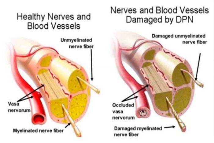 Neuropathy Relief Miami. Diabetic Peripheral Neuropathy as a Result of Ischemia. Diabetic peripheral neuropathy (DPN) is a common complication of diabetes that affects the nerves in the hands and feet.