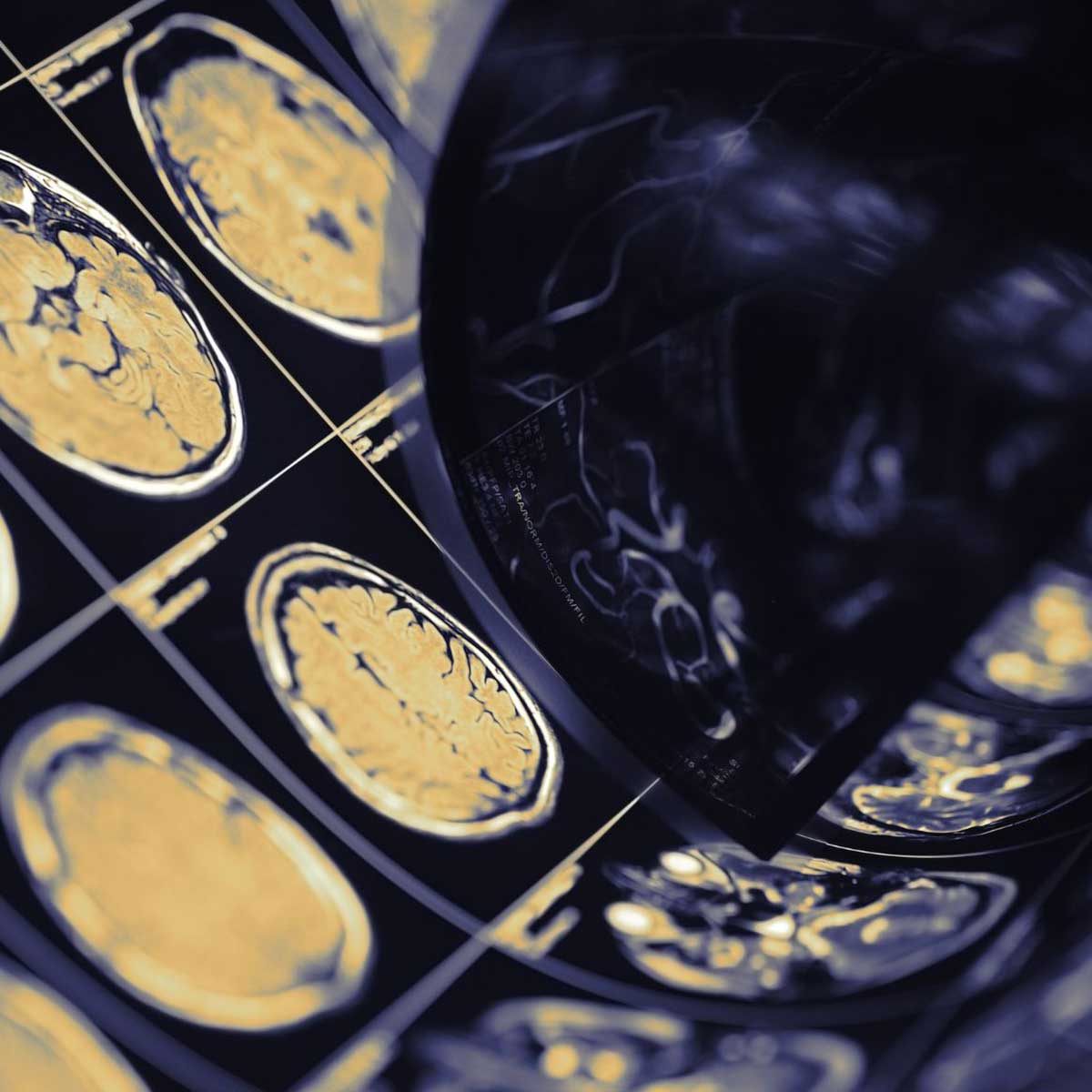 Ischemia the primary cause of peripheral sensory neuropathy